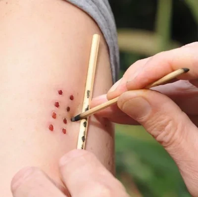 Aplicación de Kambo - Medicina purificadora amazónica